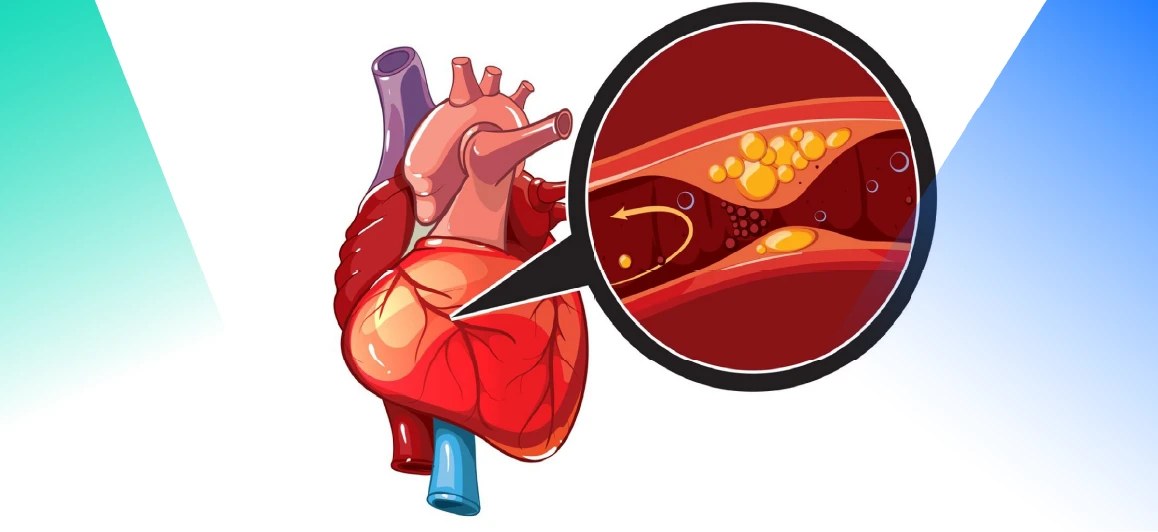 Advancing Cardiovascular Treatment: How LS-DYNA Powers High-Fidelity Stent Simulations